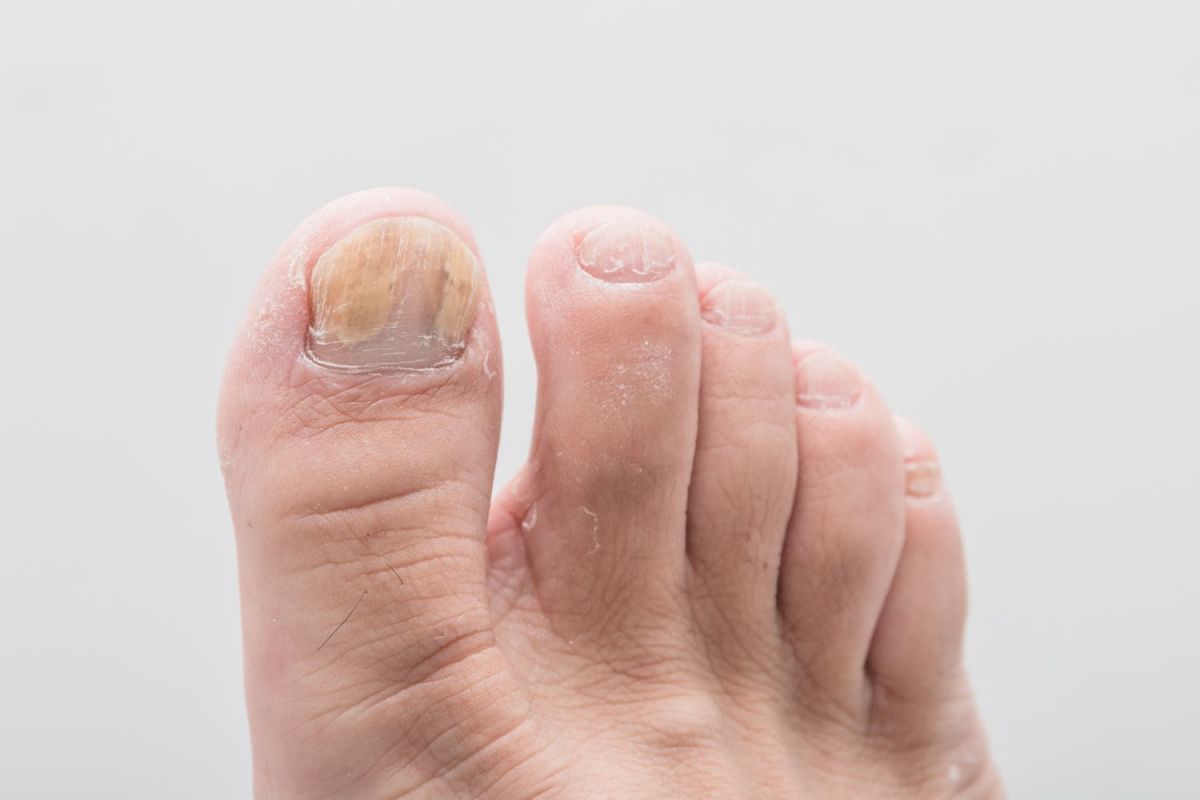 A Self-Help Guide to Managing Toenail Fungus