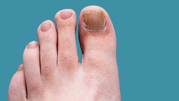 Conquering the Fungus: A Guide to Effective Toenail Treatment